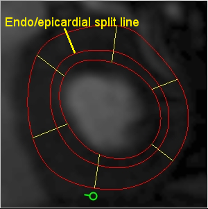 A 30% endocardium 70% epicardium split