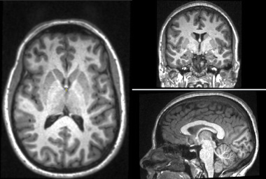 Ideal converage of the cranium for the Brain Atrophy tool