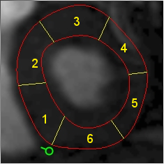 Cardiac segment numbering is increasing clockwise
                            from the insertion point handle
