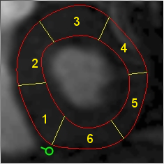 Cardiac segment numbering is increasing clockwise
from the insertion point handle