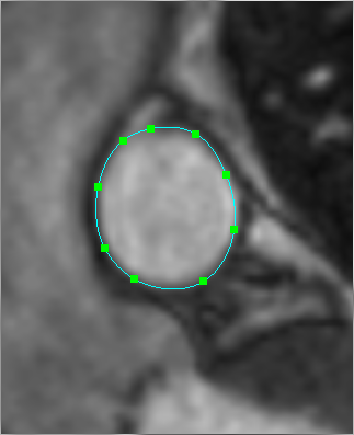 A completed Closed Spline ROI