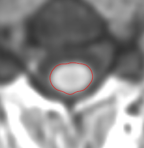 Half-way registered cord at 1 year follow-up