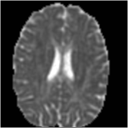 Diffusion tensor axial diffusivity image