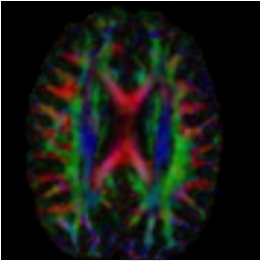 Diffusion tensor primary eigen vector direction image