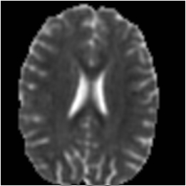 Diffusion tensor radial diffusivity image