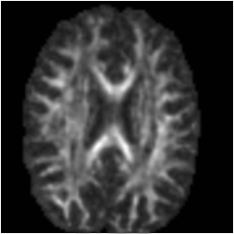 Diffusion tensor fractional anisotropy image