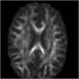 Diffusion tensor relative anisotropy image