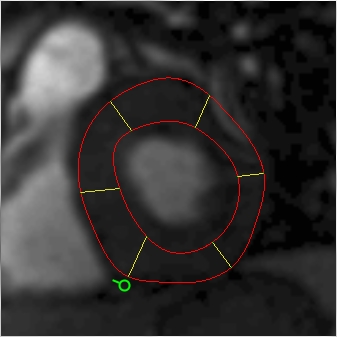 Endo- and epi-cardial borders on an MRI perfusion image