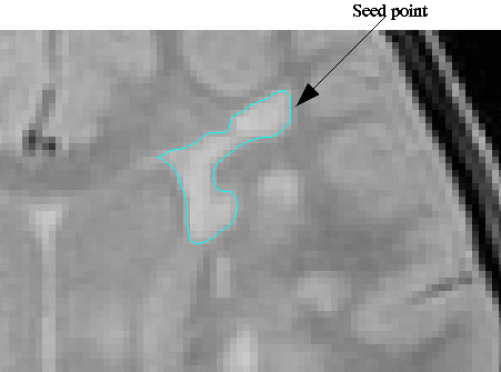 lesion_contour