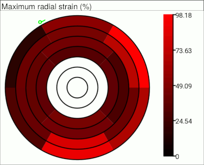 Bullseye plot of maximum radial strain