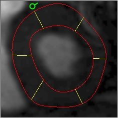 Myocardial segments starting at the anterior margin
of the RV