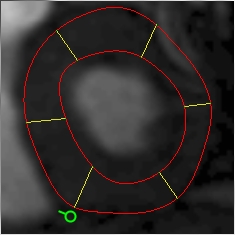 Myocardial segments starting at the posterior margin
of the RV